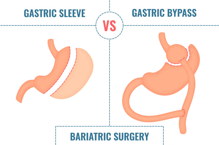 Gastric Sleeve VS Gastric Bypass