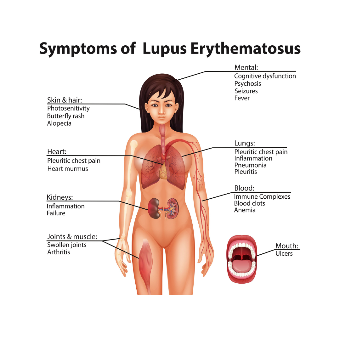 Shedding Light on Lupus: Understanding and Advocating for Awareness