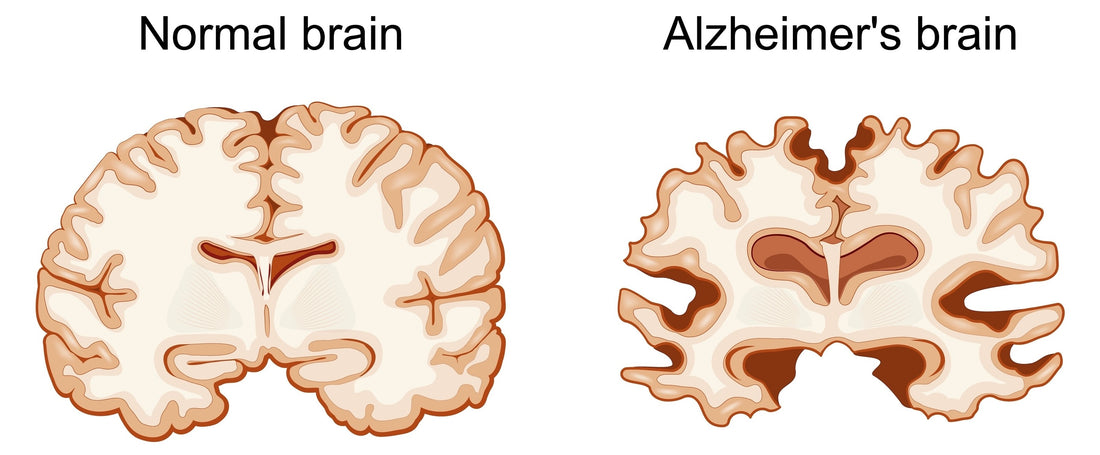 Alzheimer's and Brain Awareness Month: Shining a Light on Cognitive Health